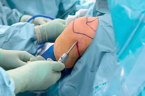 Arthroscopy of the knee joint and anterior cruciate ligament (ACL) reconstruction