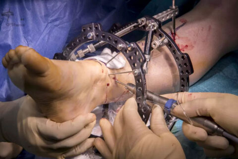Deformity correction surgery using the Ilizarov method