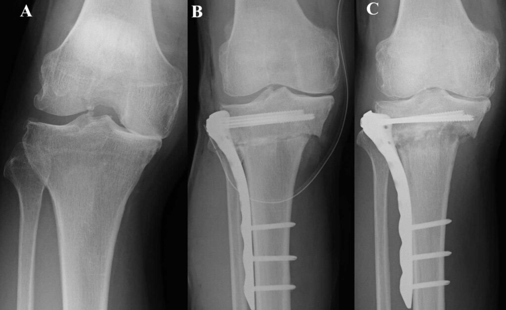 High Tibial Osteotomy And Leg Corrective Deformities Dr Issam Mardini High Tibial Osteotomy And Leg Corrective Deformities Dr Issam Mardini