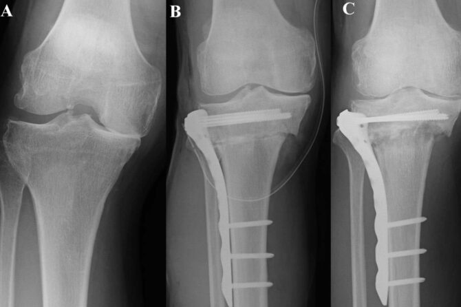 High Tibial osteotomy and leg corrective deformities - Dr Issam Mardini