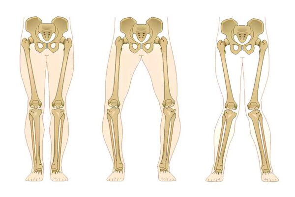 High Tibial osteotomy and leg corrective deformities - Dr Issam Mardini