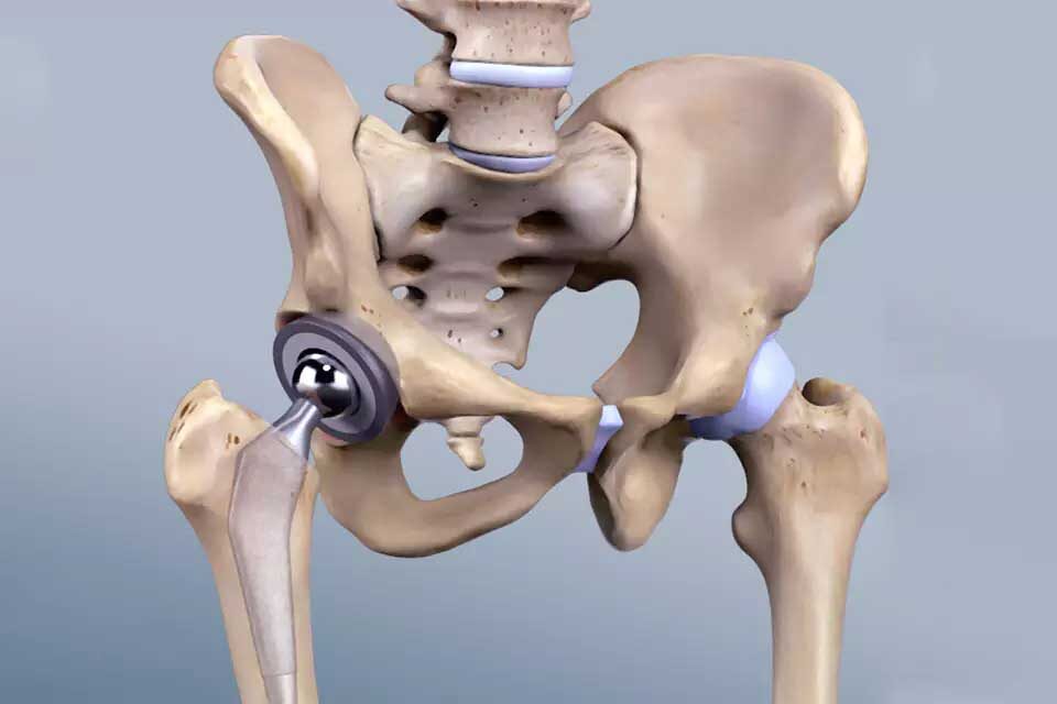 Joint replacements of hip knees and shoulders replacement and revision ...