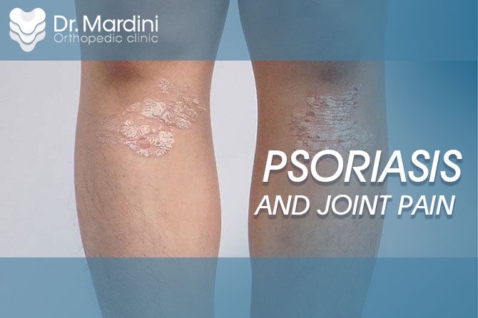 Psoriasis and joint pain