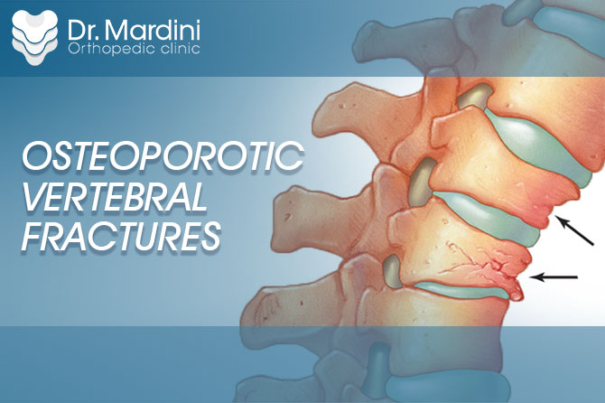 osteoporotic vertebral fractures