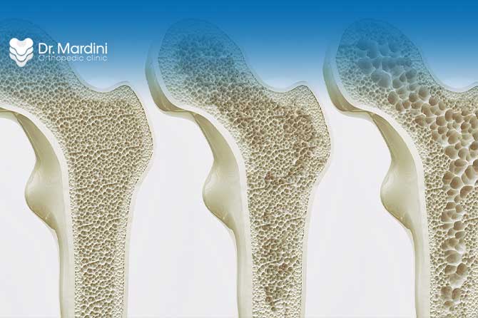What is the risk of complications from osteoporosis?